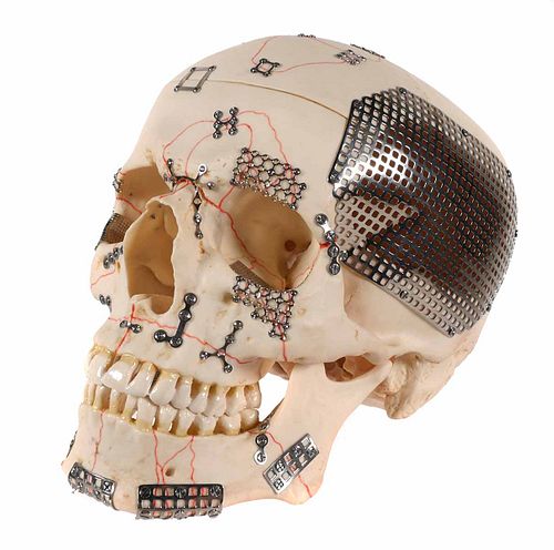 Cranioplasty Medical Skull Sculpture