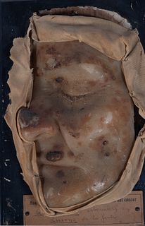 Face of a patient with Wax Keratosis, Spain, first half of the 20th century
