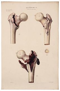 * CRUVEILHIER, Jean (1791-1874). Anatomie pathologique du corps humain. Paris: J.-B. Baillière, 1829-1842. FIRST EDITION.