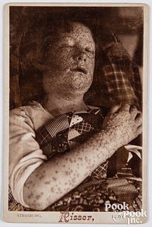 Cabinet card photograph of a smallpox patient
